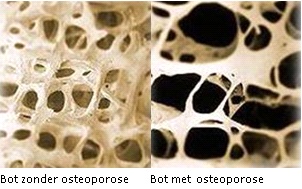 osteoporose botontkalking